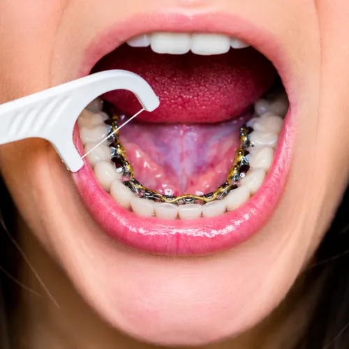 Flossing tool in mouth of woman with braces on the back of her bottom teeth.