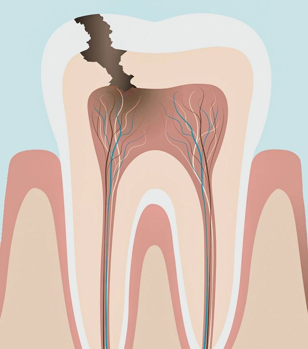 An image of the anatomy of a tooth showing progressing dental decay