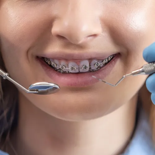 Smiling young woman wearing clear aligners to straighten her teeth.