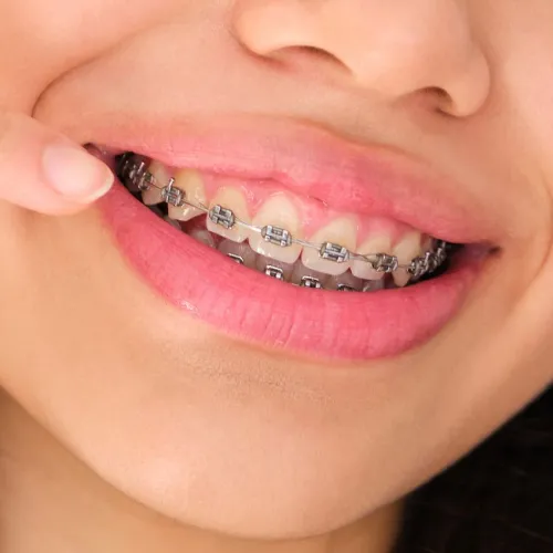 Close-up of a patient smiling with metal braces on their upper and lower teeth.