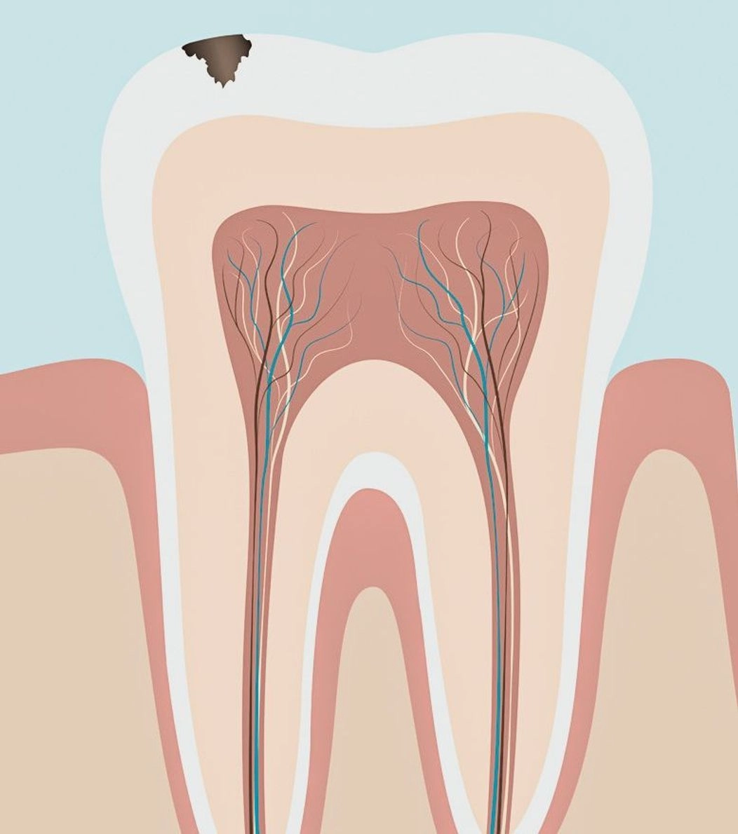 An image of the anatomy of a tooth showing a cavity