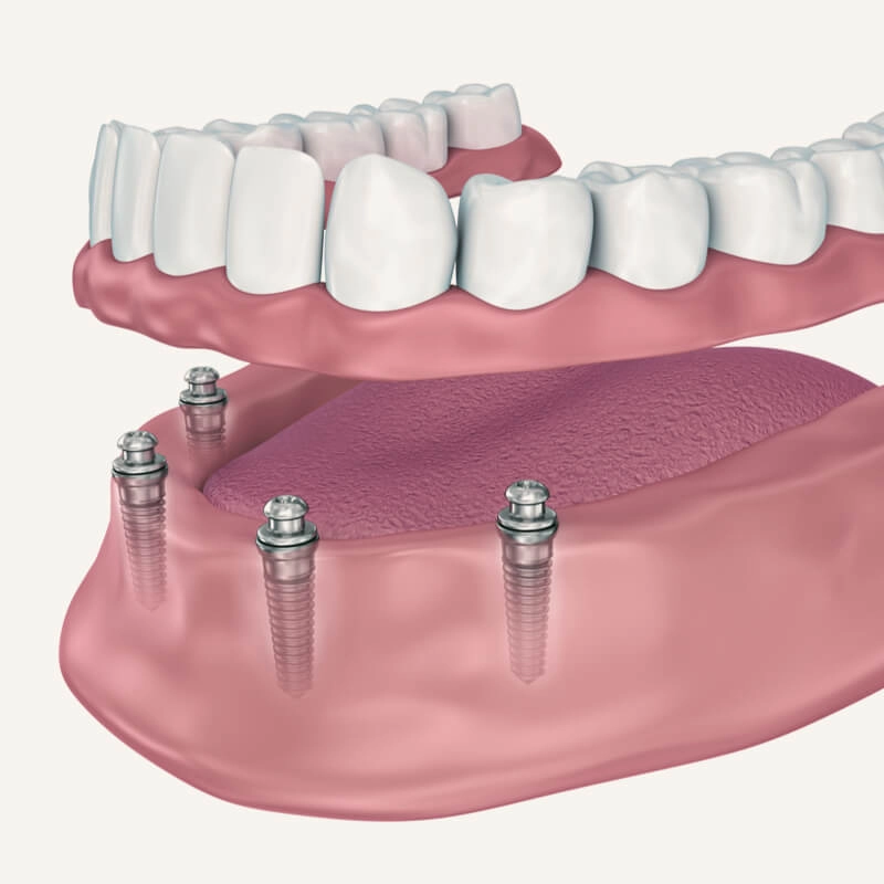 3D rendering of implant supported dentures