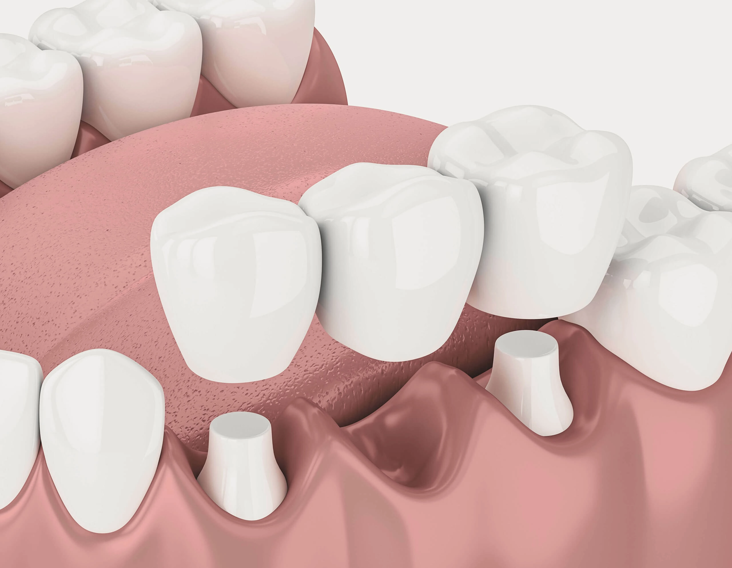 Image of a dental bridge 