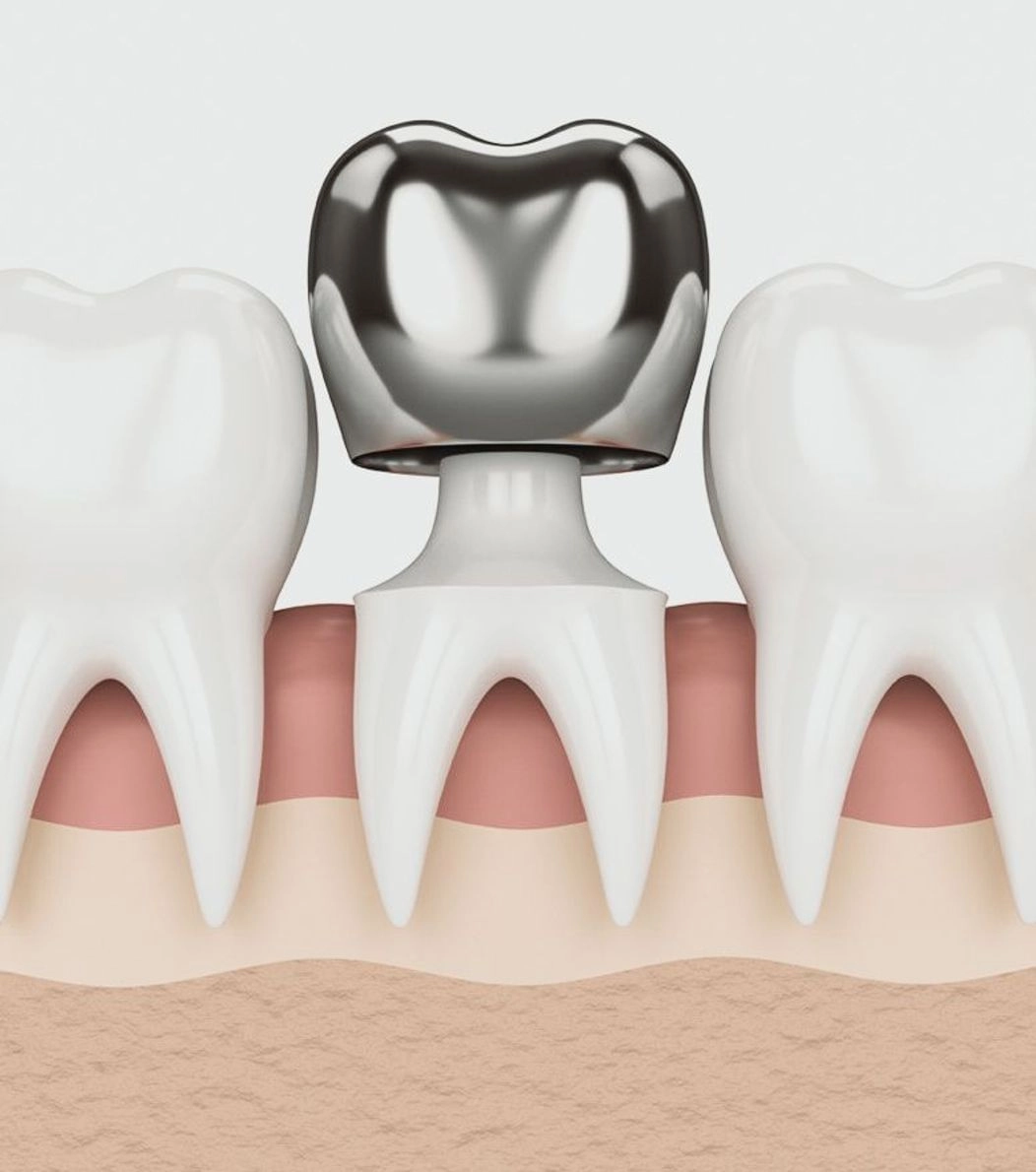 An image of a metal crown being placed on a tooth