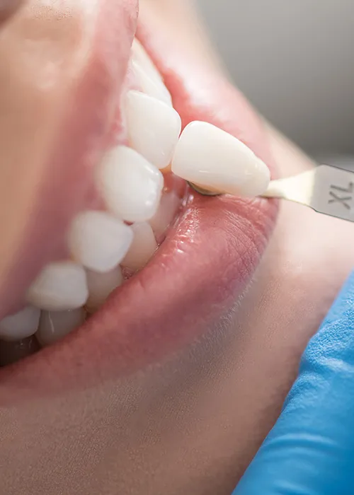 Smile with veneers