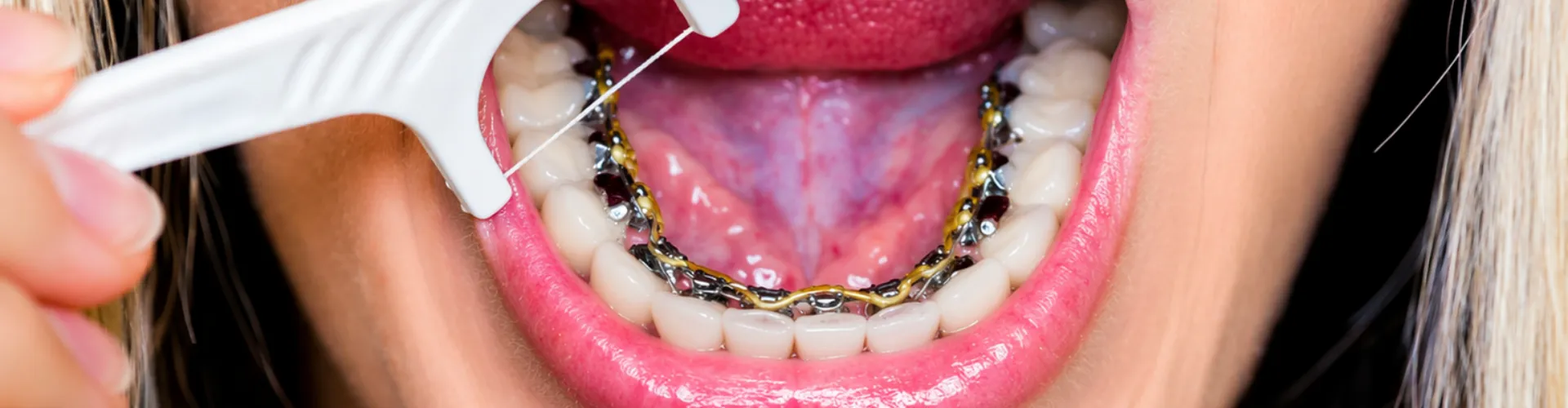 Flossing tool in mouth of woman with braces on the back of her bottom teeth.