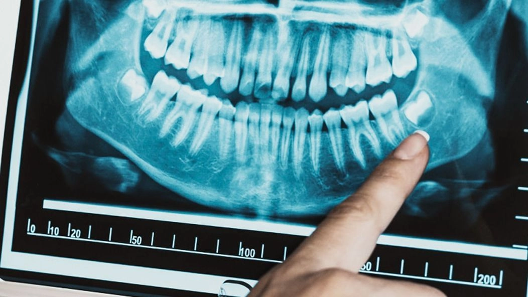 An image of a dental XRAY showing a growing wisdom tooth