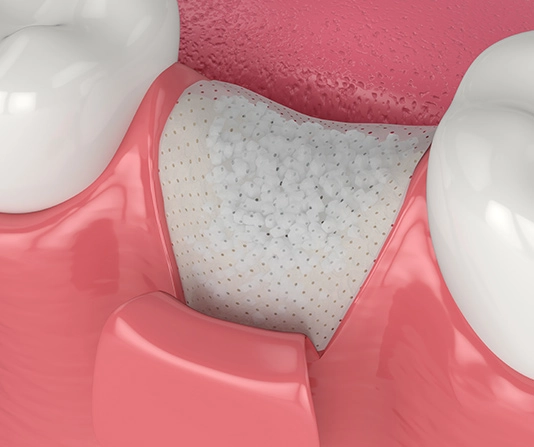 Bone grafting illustration