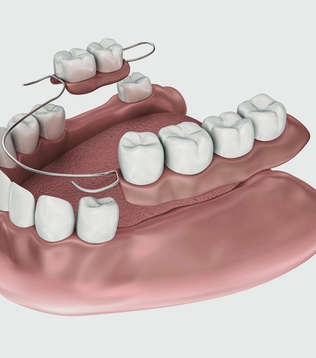 An image of partial dentures being placed