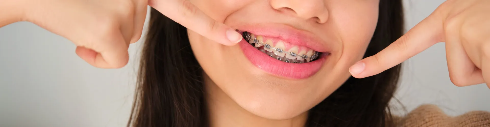 Close-up of a patient smiling with metal braces on their upper and lower teeth.