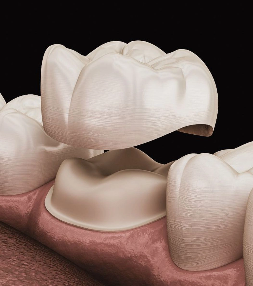 An image of a porcelain dental crown being placed on a tooth