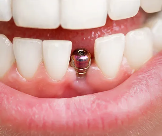 Mouth with dental screw in it